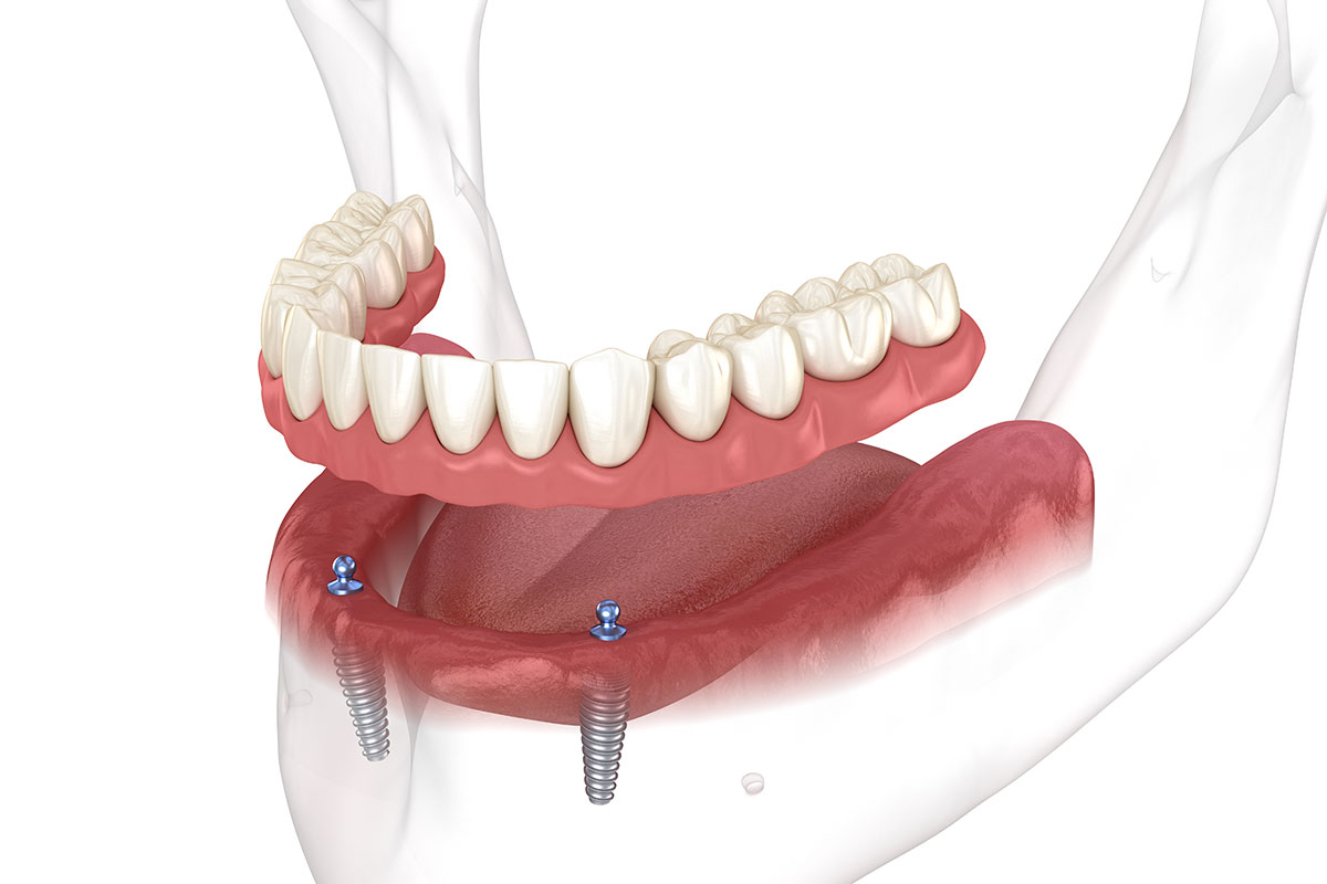 Dental 3D illustration of implant dentures. Mandibular removable prosthesis supported by implants with ball attachments.